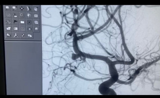 HGP destaca saldo positivo de procedimento inovador na área de neurocirurgia