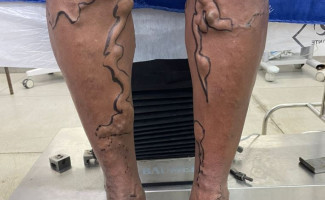 Hospital Regional de Augustinópolis retoma cirurgias de angiologia