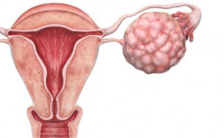 SES-TO alerta mulheres sobre o câncer de ovário
