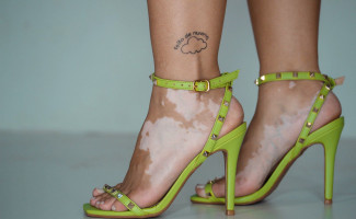 SES-TO destaca o Dia Nacional dos Portadores de Vitiligo