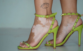 SES-TO destaca a importância da conscientização e do combate ao preconceito no Dia Nacional dos Portadores de Vitiligo