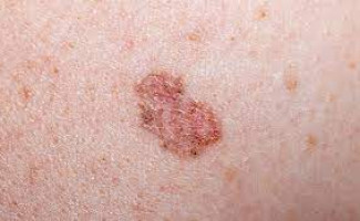 SES-TO alerta para a prevenção contra o Câncer de Pele Não Melanoma

