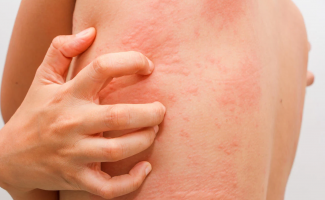 Dia Mundial da Alergia, SES-TO alerta para cuidados preventivos

 