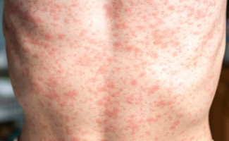 Nota de esclarecimento 24 – sarampo no Tocantins