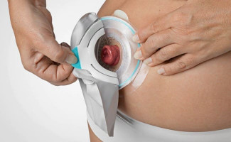 No Dia Nacional dos Ostomizados, a SES-TO destaca a importância da informação no combate ao preconceito