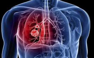 Tocantins destaca as ações de combate e prevenção da tuberculose 