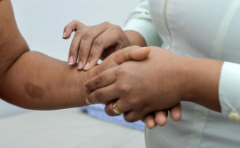 Governo do Tocantins intensifica ações de conscientização e enfrentamento da hanseníase durante o Janeiro Roxo