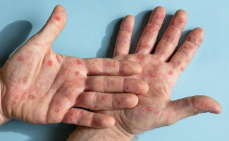 SES-TO divulga Nota Informativa sobre a Vigilância da Mpox no Tocantins