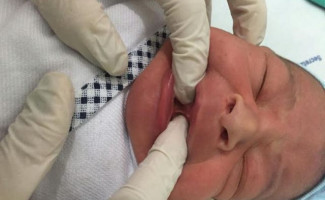 Teste da Linguinha passa a ser oferecido a bebês no Hospital Tia Dedé