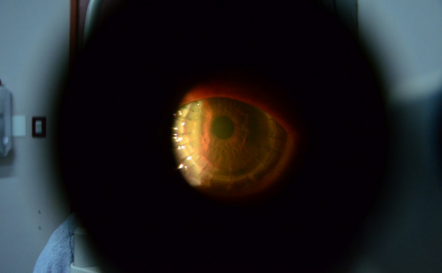 A córnea é um tecido localizado em frente à pupila e é fundamental que ela tenha transparência e formato normal para ter uma boa visão 