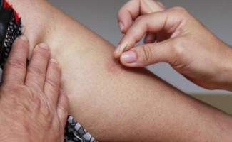 Dia Estadual de Luta contra a Hanseníase é celebrado nesta sexta-feira, 27