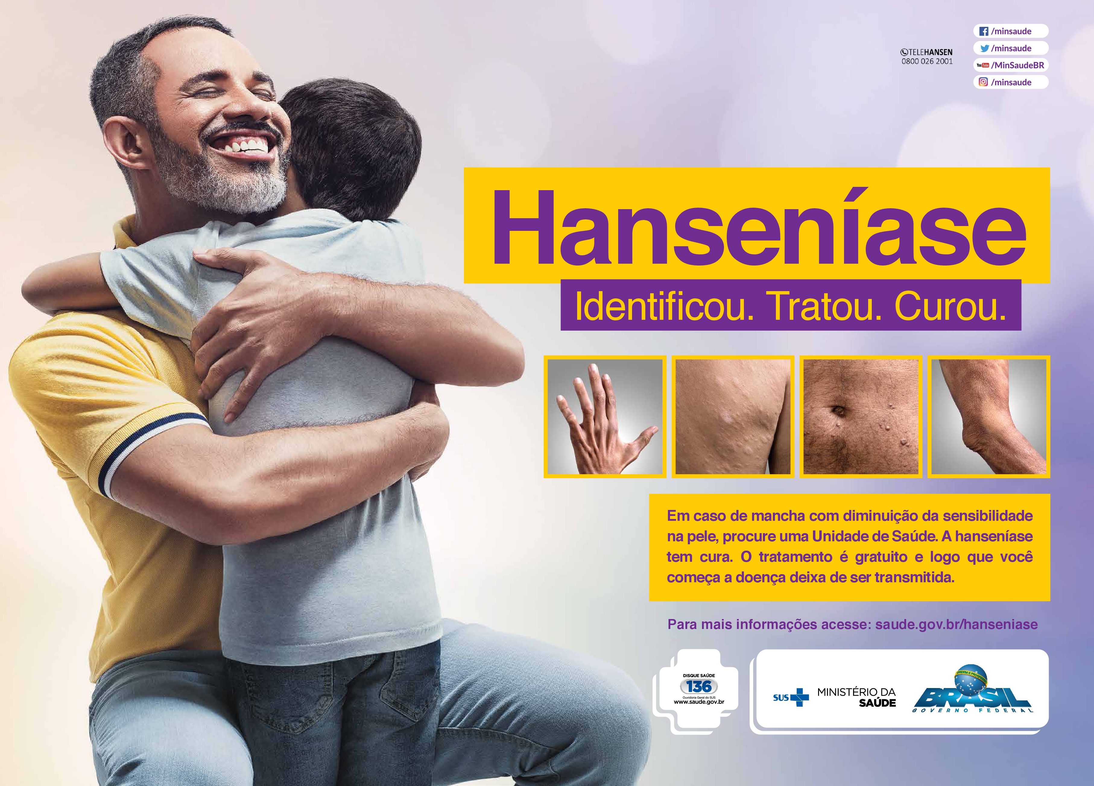 GazetaWeb - Saúde reforça alerta sobre sinais e sintomas da Hanseníase