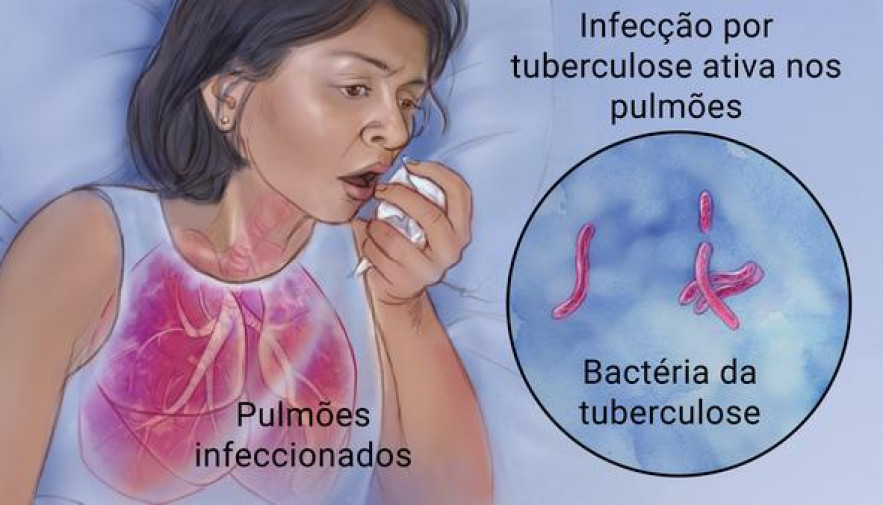 Saúde mobiliza municípios no Dia Mundial de Combate a Tuberculose