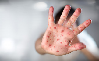 Saúde ressalta que Tocantins não tem casos confirmados de Sarampo