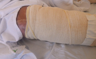 Saúde alerta sobre risco de queimaduras durante a quarentena