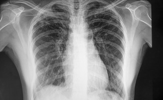 Dia Mundial de Combate à Tuberculose mobiliza profissionais de Saúde