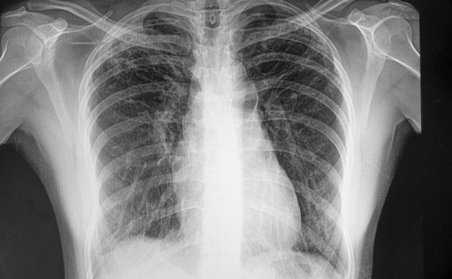Tuberculose tem cura e o tratamento é gratuito no Sistema Único de Saúde 